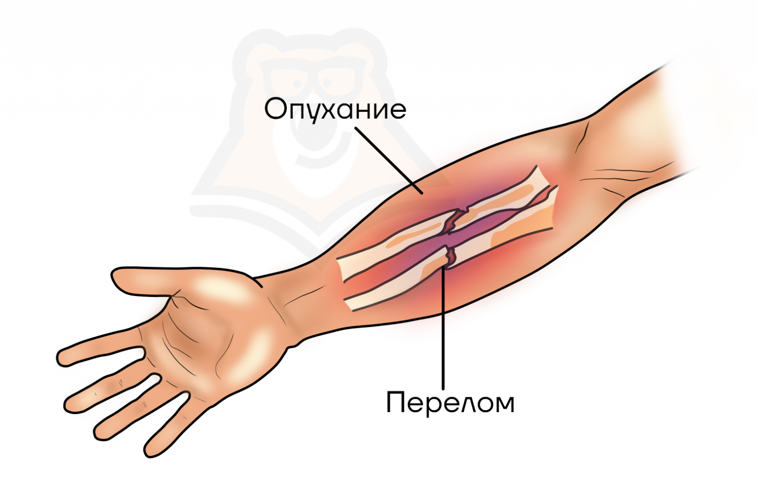 Трещина в кисти. Перелом лучевой кости руки симптомы. Признаки трещины лучевая кость. Трещина кости предплечья симптомы. Перелом предплечья и кисти.